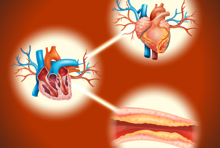 Dislipidemia